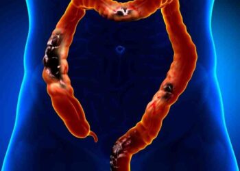 10-symptomes-du-cancer-du-colon-a-ne-pas-ignorer