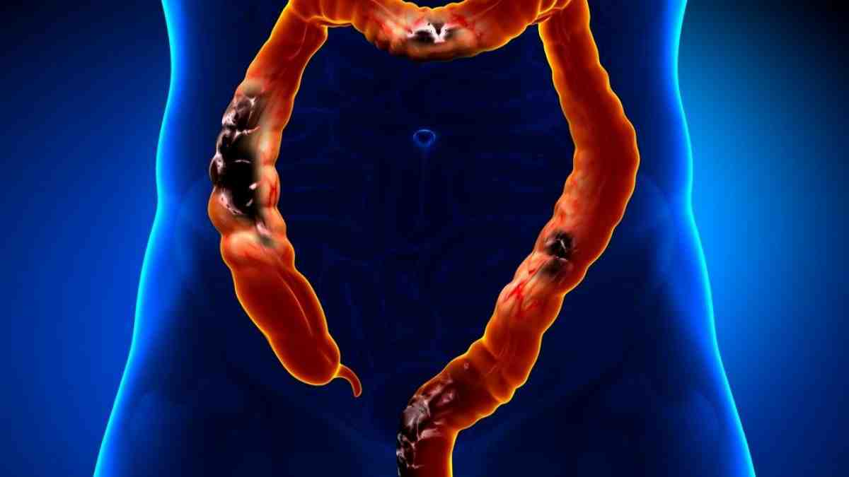 10-symptomes-du-cancer-du-colon-a-ne-pas-ignorer