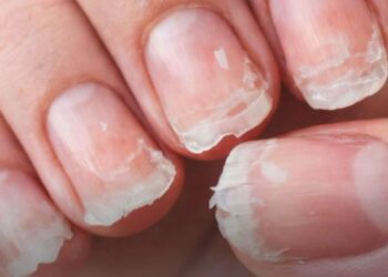 vos-ongles-se-cassent-ou-se-dedoublent-ce-que-cela-peut-reveler-sur-votre-sante