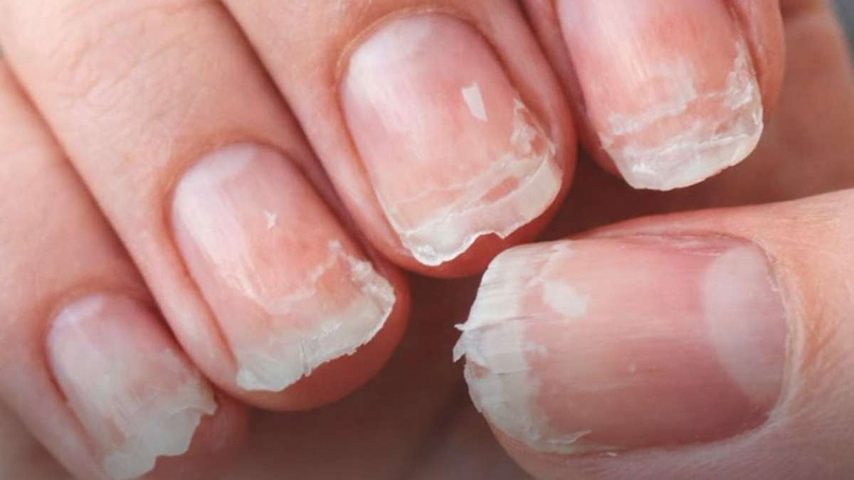 vos-ongles-se-cassent-ou-se-dedoublent-ce-que-cela-peut-reveler-sur-votre-sante
